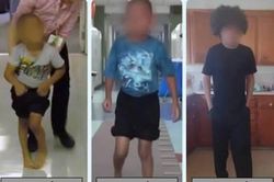 Kỹ thuật cắt rễ thần kinh chọn lọc giúp trẻ bại não cải thiện vận động