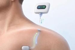 Phát triển thành công ổ cắm sinh học dưới da, sạc pin thiết bị y tế chỉ bằng một lần đâm kim