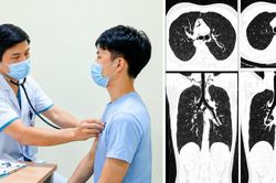 Nam thanh niên 20 tuổi tràn khí trung thất sau 1 tuần ho liên tục, bác sĩ cảnh báo dấu hiệu dễ bị bỏ qua