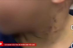 Cháu bé 3 tuổi bị cha dượng bạo hành