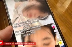 ĐH Y Hà Nội: Kỷ luật nghiêm nữ sinh dọa lấy ven bệnh nhân trật 3 lần