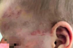 Điều tra vụ bé trai 3 tuổi bị cha dượng đánh chấn động não