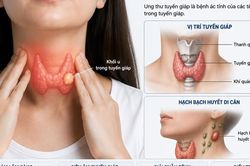 Sau mổ ung thư tuyến giáp, ai cần điều trị I-131?