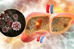 Nguyên nhân hàng đầu gây ung thư gan ở Việt Nam