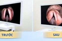 Điều trị thành công ca hở thanh môn do liệt dây thanh bằng tiêm mỡ tự thân