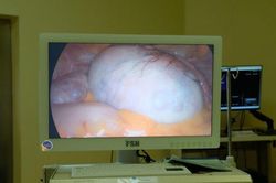 C&ocirc; g&aacute;i 26 tuổi ph&aacute;t hiện u buồng trứng k&iacute;ch thước 15cm từ dấu hiệu nhiều người Việt dễ bỏ qua
