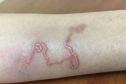 Nhóm người tuyệt đối không được quên tẩy giun