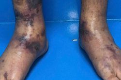 Chẩn đo&aacute;n v&agrave; điều trị th&agrave;nh c&ocirc;ng trường hợp mắc bệnh vi&ecirc;m mạch hiếm gặp
