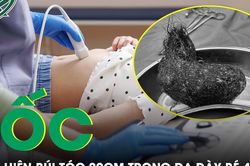 B&eacute; g&aacute;i 4 tuổi đau bụng triền mi&ecirc;n, b&aacute;c sĩ sốc khi lấy ra b&uacute;i t&oacute;c d&agrave;i gần 20cm trong dạ d&agrave;y