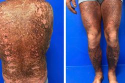 Cảnh báo nguy cơ da đau rát, tổn thương nặng do tự ý bôi thuốc điều trị vảy nến