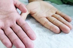 Bé 4 tuổi cấp cứu vì chỉ uống sữa thay cơm: BS chỉ ra sai lầm phổ biến