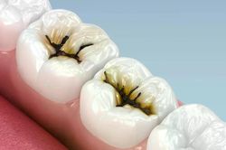 Phương pháp điều trị sâu răng đơn giản và an toàn
