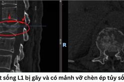 Ngã từ mái nhà, người đàn ông suýt liệt vì gãy đốt sống thắt lưng
