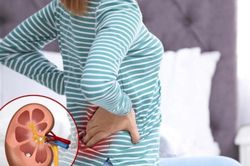 Sỏi thận âm thầm gây suy thận như thế nào?