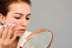 Mách bạn cách chọn kem chấm mụn chuẩn y khoa giúp gom cồi, mờ thâm nhanh