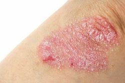 Cách chăm sóc da hàng ngày với người bệnh vảy nến để kiểm soát bệnh hiệu quả