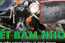 Sau 5 ngày tự theo dõi vết bầm, người phụ nữ nhập viện trong tình trạng sốc nhiễm khuẩn