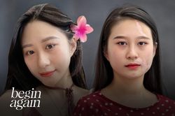 Cô gái bị hủy mặt vì bạch biến thay đổi sau 6 năm điều trị