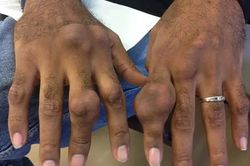 Bác sĩ cảnh báo về nguy cơ tàn phế khi coi nhẹ bệnh gout