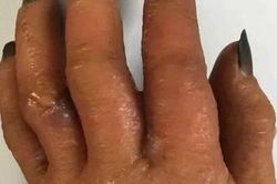 Nguy cơ dị ứng từ thuốc nhuộm tóc, lời khuyên từ bác sĩ da liễu