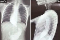 Nuốt nghẹn suốt 3 năm, bé trai 10 tuổi mắc co thắt tâm vị hiếm gặp