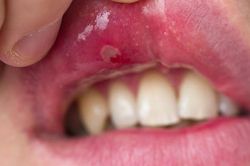 5 lưu ý chăm sóc răng miệng cho người bệnh Lupus ban đỏ