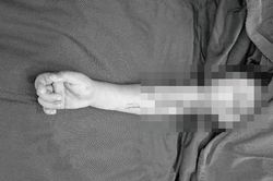 Nối liền c&aacute;nh tay cho b&eacute; 4 tuổi gặp tai nạn với &aacute;o chống nắng