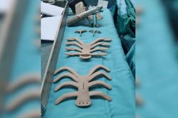 Lần đầu cấy ghép toàn bộ lồng ngực in 3D cứu bệnh nhân mắc ung thư hiếm