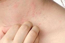 Ngứa, nổi mề đay có phải là triệu chứng sớm của bệnh gan?