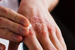 Cần làm gì khi nghi ngờ bị viêm da tiếp xúc?
