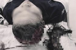 Tóc cuốn vào máy cắt gỗ, người phụ nữ bị lột toàn bộ da đầu