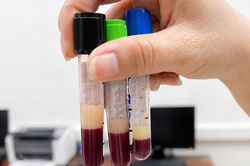 Hình ảnh xuất hiện trong ống máu của người đàn ông 40 tuổi khiến bác sĩ lo ngại