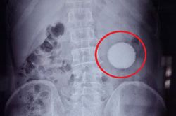 Đau bụng 20 năm trời, người đàn ông sốc khi bác sĩ gắp ra thứ 'đáng sợ' trong bụng