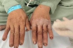 Tự nhuộm tóc tại nhà, người đàn ông bất ngờ phải nhập viện vì lý do không ai ngờ đến