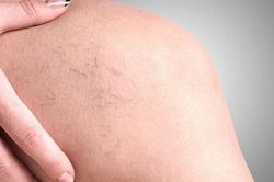 3 biến chứng nguy hiểm khi bị suy giãn tĩnh mạch chân