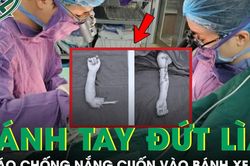 Cận cảnh ca phẫu thuật nối cánh tay đứt rời của bé trai 4 tuổi do áo chống nắng cuốn vào bánh xe