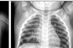 Bé trai 3 tuổi ho kéo dài hơn một tháng do dị vật trong phế quản