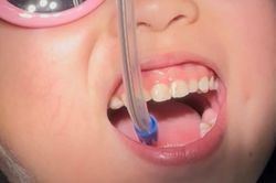Lý do tiến sĩ dược làm việc ở Mỹ đưa con về Việt Nam chữa răng sâu