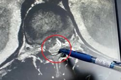 Ăn món khoái khẩu, người đàn ông 55 tuổi 'rước' ấu trùng sán dây vào tủy sống suốt 12 năm mà không hay
