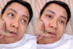 Hoài Lâm gây xôn xao với tình trạng lạ