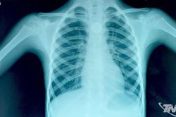 Bệnh viện Đa khoa Bắc Kạn gắp thành công pin điện tử mắc trong thực quản bé trai 5 tuổi
