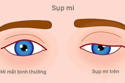 Bệnh lý sụp mi và những điều cần biết