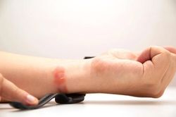 Thủ phạm khiến cổ tay ngứa điên đảo khi đeo đồng hồ dây silicone?