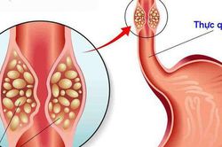 Triệu chứng hẹp thực quản: Đừng chủ quan khi thường xuy&ecirc;n nuốt nghẹn