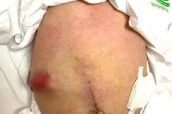 Cứu sống trẻ sơ sinh viêm phúc mạc toàn thể do thủng đại tràng