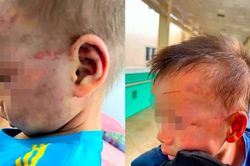 Khởi tố cha dượng đánh bé 3 tuổi bầm tím mặt mũi