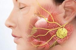 Sưng đau v&ugrave;ng mang tai, coi chừng bệnh l&yacute; tuyến nước bọt
