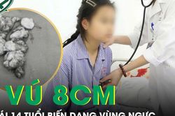 Bé gái 14 tuổi có khối u vú 8cm gây biến dạng