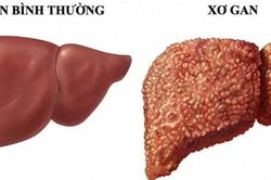 Chưa bị xơ gan vẫn có thể mắc ung thư gan