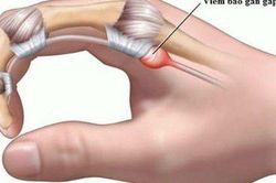 Ngón tay đau hoặc bật lò xo, cảnh giác với viêm gân gấp ngón tay